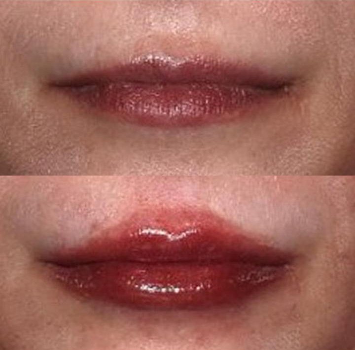 Antes e depois preenchimento labial