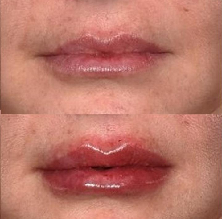 Antes e depois preenchimento labial