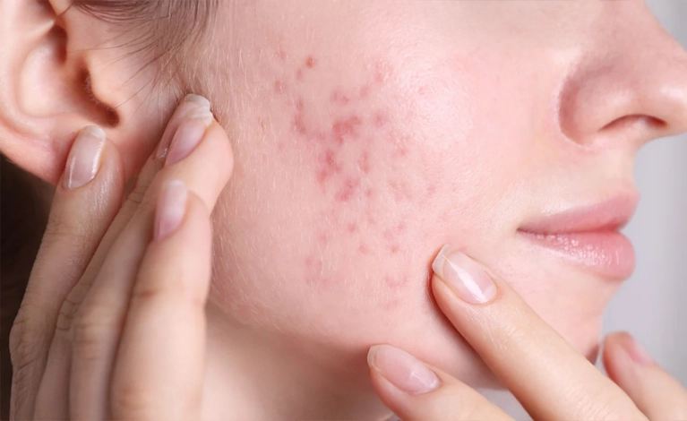 Manchas de acne