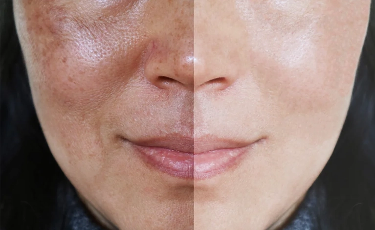 Tratamento de melasma