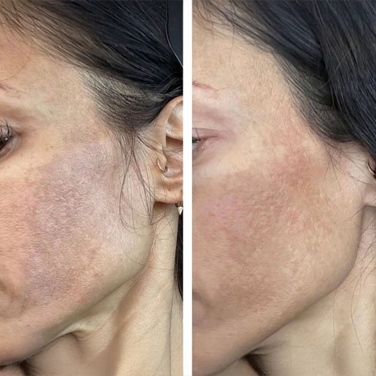 Antes e depois Discovery Pico