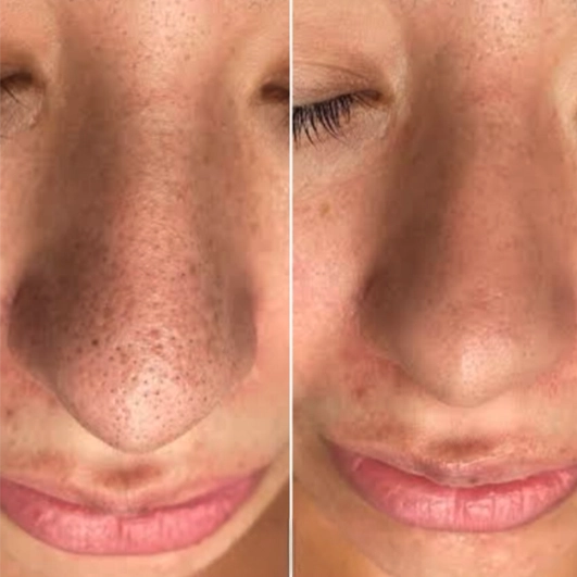 Antes e depois Discovery Pico