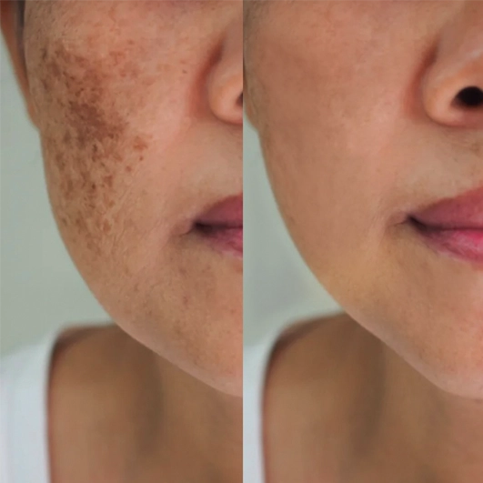 Antes e depois Discovery Pico