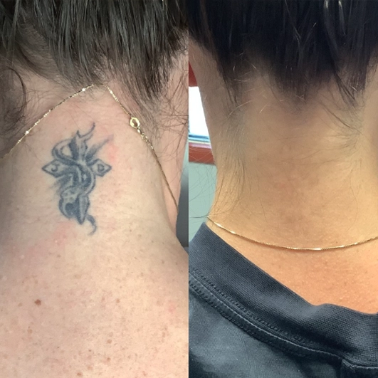 Antes e depois Discovery Pico