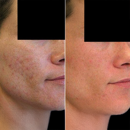 Antes e depois Discovery Pico