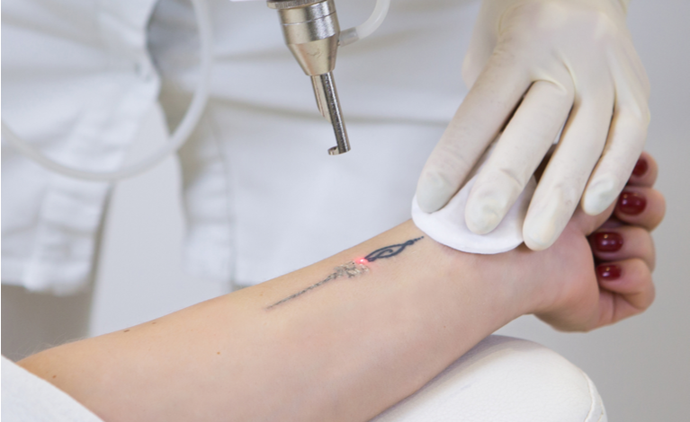Remoção de tatuagem