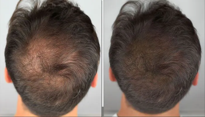 Antes e depois tratamento capilar