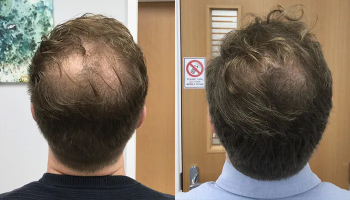 Antes e depois tratamento capilar