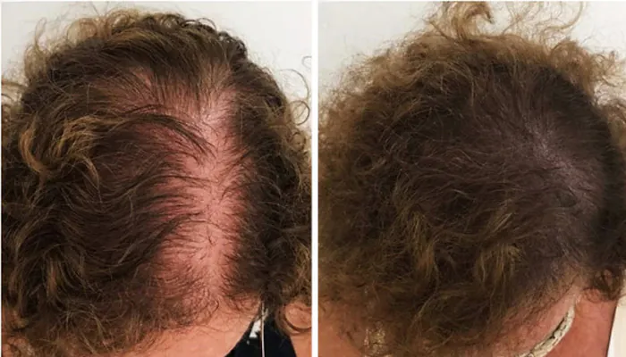 Antes e depois tratamento capilar